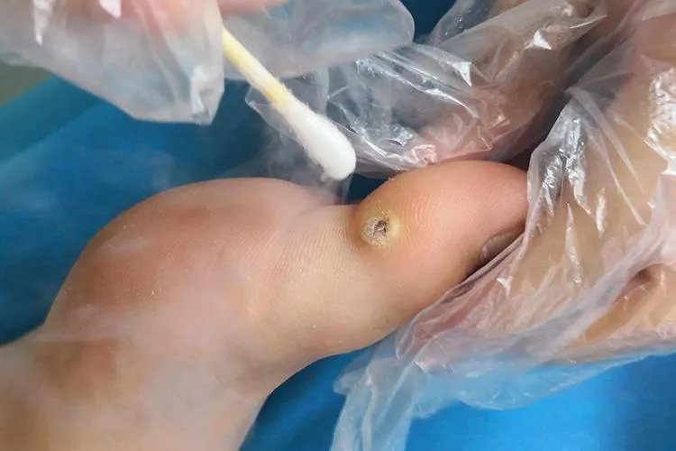 脚趾头长肉刺图片