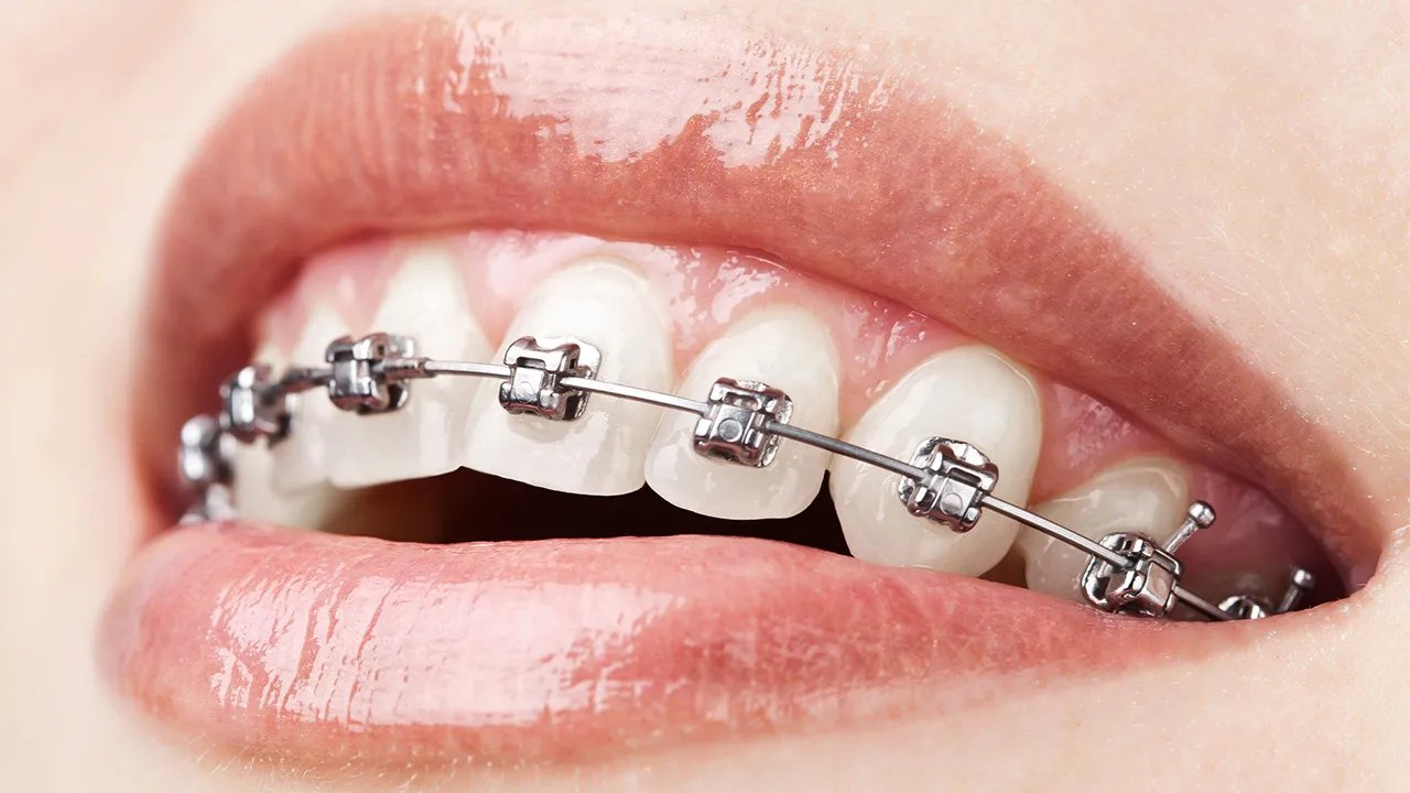 怎么矫正牙齿