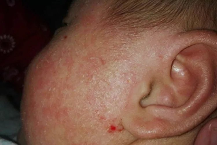 小孩面部湿疹症状图片