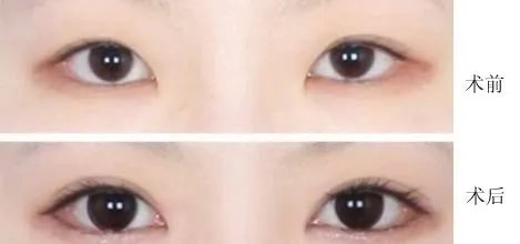 开眼角效果有哪些