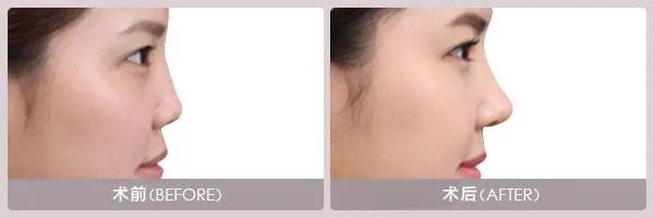 注射隆鼻效果好吗