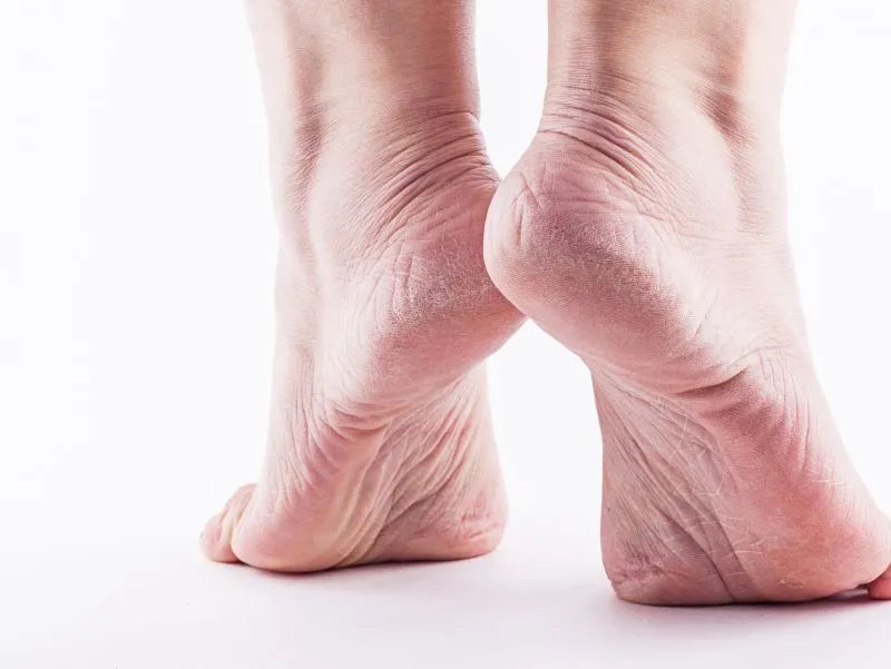 脚裂口是什么原因