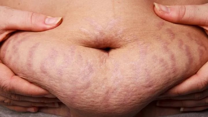 妊娠纹该怎么治疗