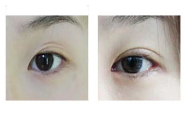 北京哪家医院做双眼皮修复好？