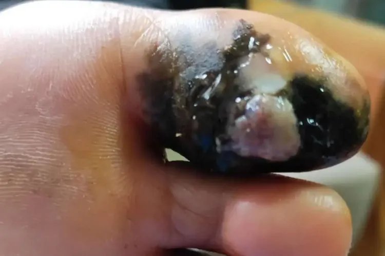 大脚趾头黑色素瘤图片