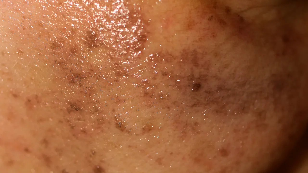 蝴蝶斑最佳治疗方法