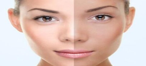 黑脸娃娃激光美容