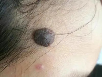 脂溢性角化病黑痣图片