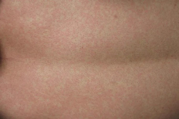 小儿麻疹的症状图片