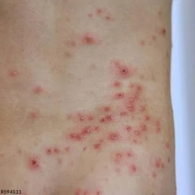 痤疮的治疗费用大概是多少钱