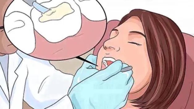 如何修复牙釉质