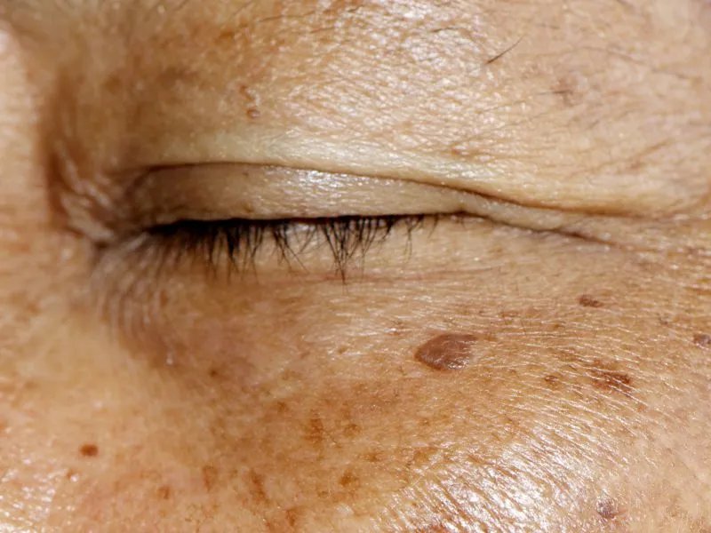 怎样去除脸上的黄褐斑