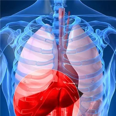 肝胆管结石症状有哪些?