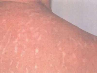 神经官能症性表皮剥脱条纹图片