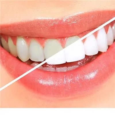 冷光美白牙齿效果好吗