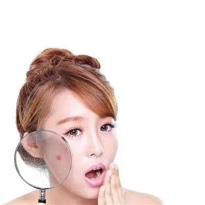 怎么除青春痘的治疗方法