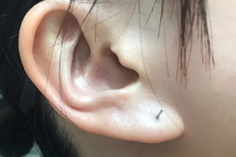 什么样的耳洞算养好了