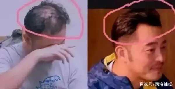 吴彦祖陷秃顶危机，黄晓明最意外， 5位遭遇“头发危机”的男明星都有谁？