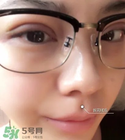 三点定位双眼皮过程图 做三点定位双眼皮心得