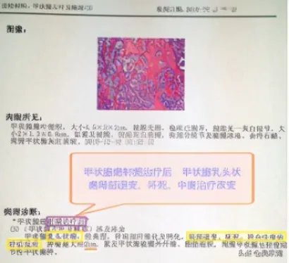 甲状腺癌慎用射频消融治疗