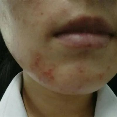 去除黑头粉刺的方法有哪些