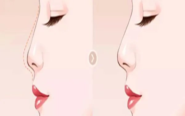 隆鼻整形北京哪家医院好?