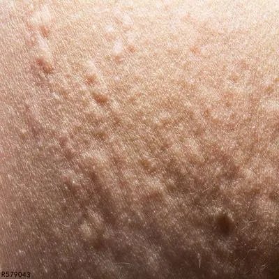 重型急性荨麻疹如何治疗