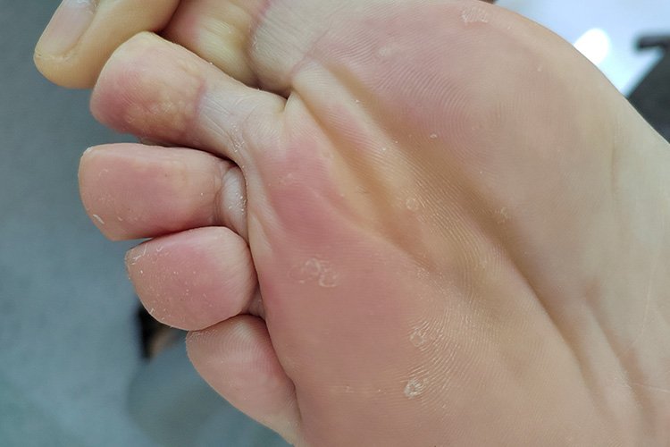 脚底皮肤病症状及图片
