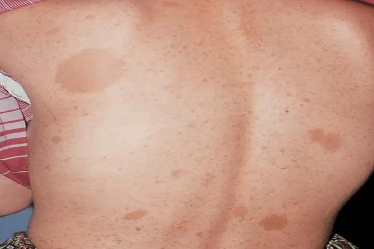 什么是咖啡斑图片