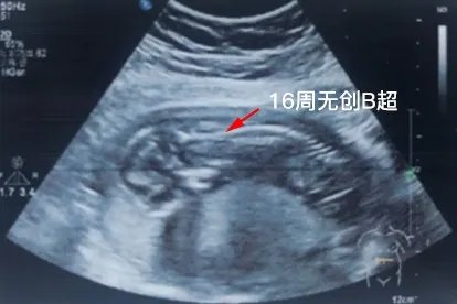 16周做无创时的B超单图片