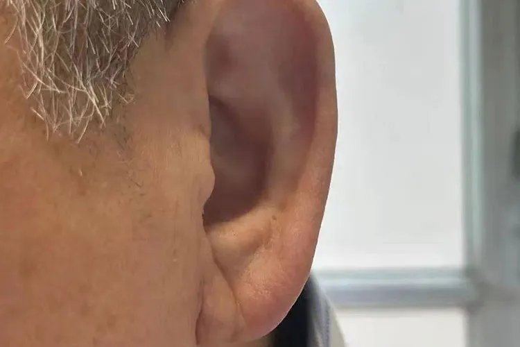 耳褶心征的鉴别图