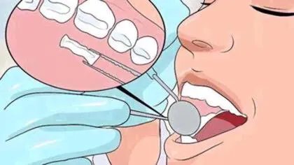 如何修复牙釉质