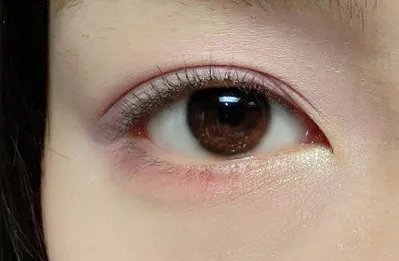 割双眼皮一般多少钱