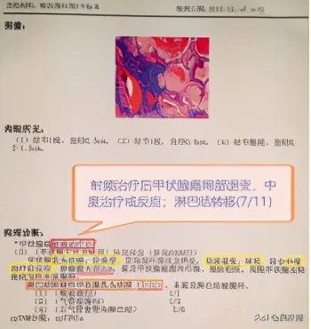 甲状腺癌慎用射频消融治疗