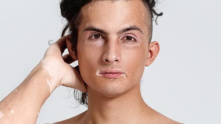 白癜风的相关介绍