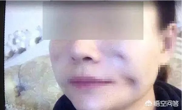 如何看待长沙女子脸部整容整出八个坑，恢复期要很久？