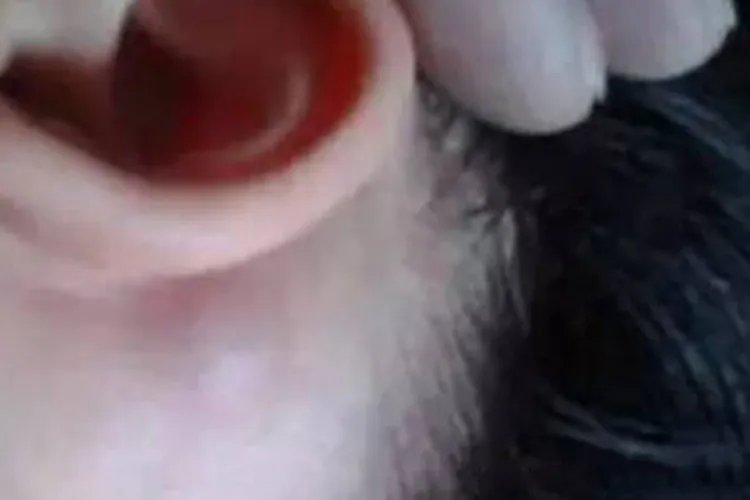 川崎病颈部肿块图片