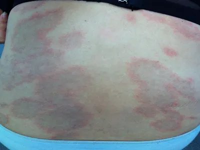 持久性色素异常性红斑背部红斑图片