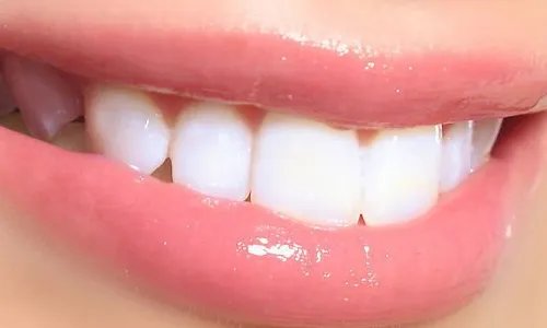 牙齿矫正一般多少钱