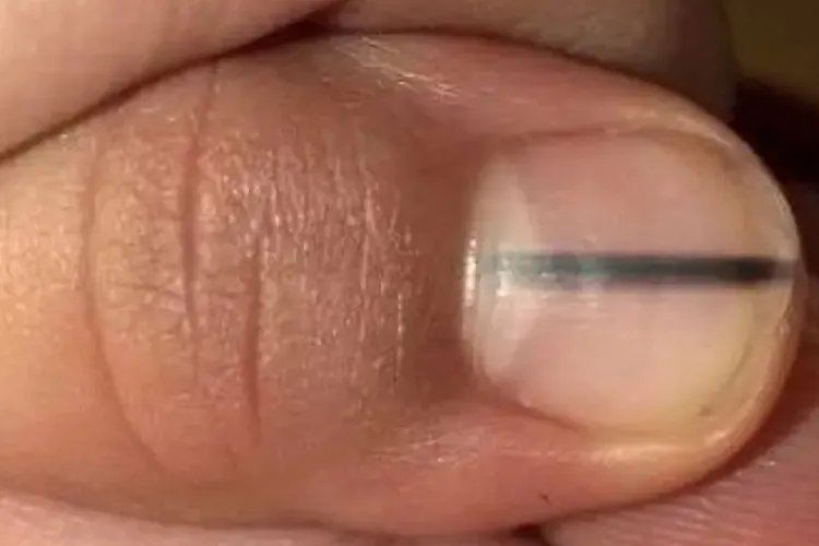 甲下黑色素瘤和瘀血照片对比