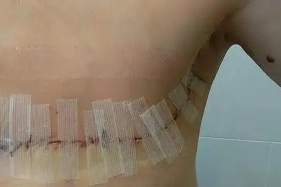 乳腺全切手术瘢痕图片