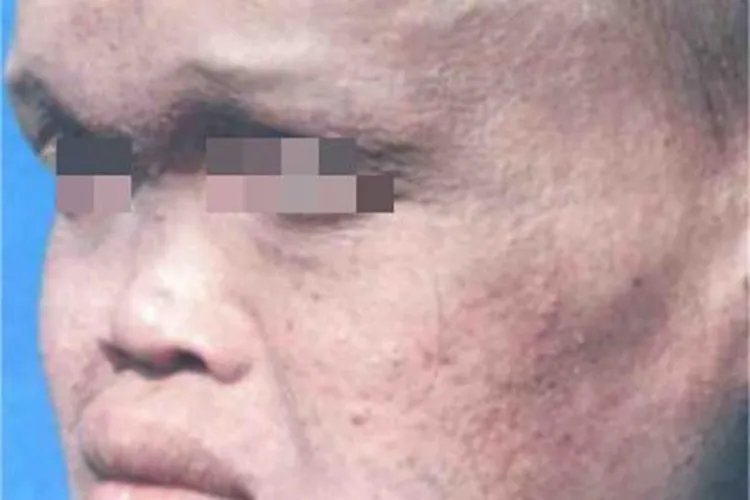 先天性外胚叶发育不良特殊面容图片