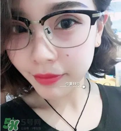 三点定位双眼皮过程图 做三点定位双眼皮心得