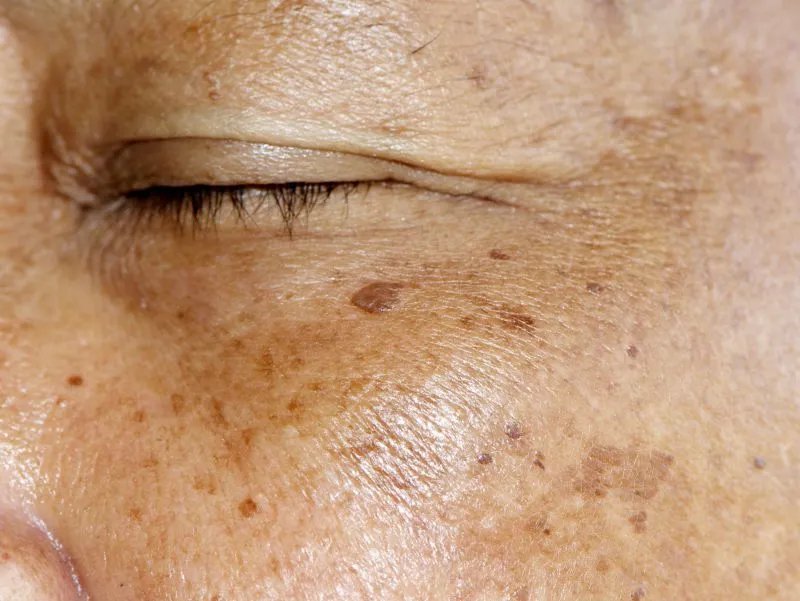 怎样去除脸上的黄褐斑