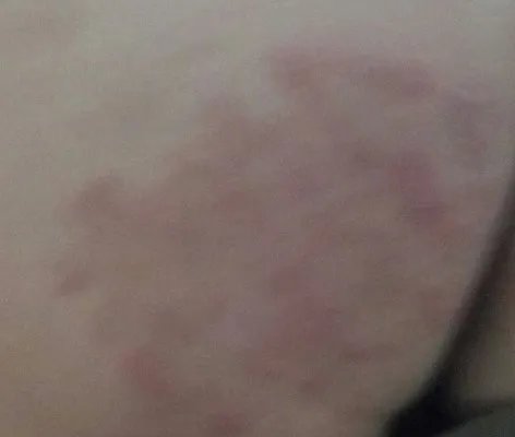 过敏什么症状图片