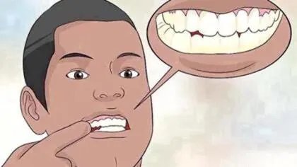 如何修复牙釉质