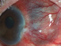 激素治疗系统性红斑狼疮合并巩膜炎