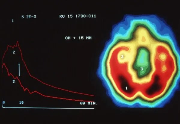 Radiology:胎儿脑组织究竟如何发育？MRI带你来看看