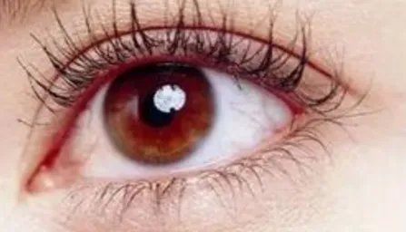 北京割双眼皮价格