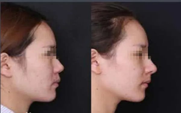 隆鼻整形北京哪家医院好?